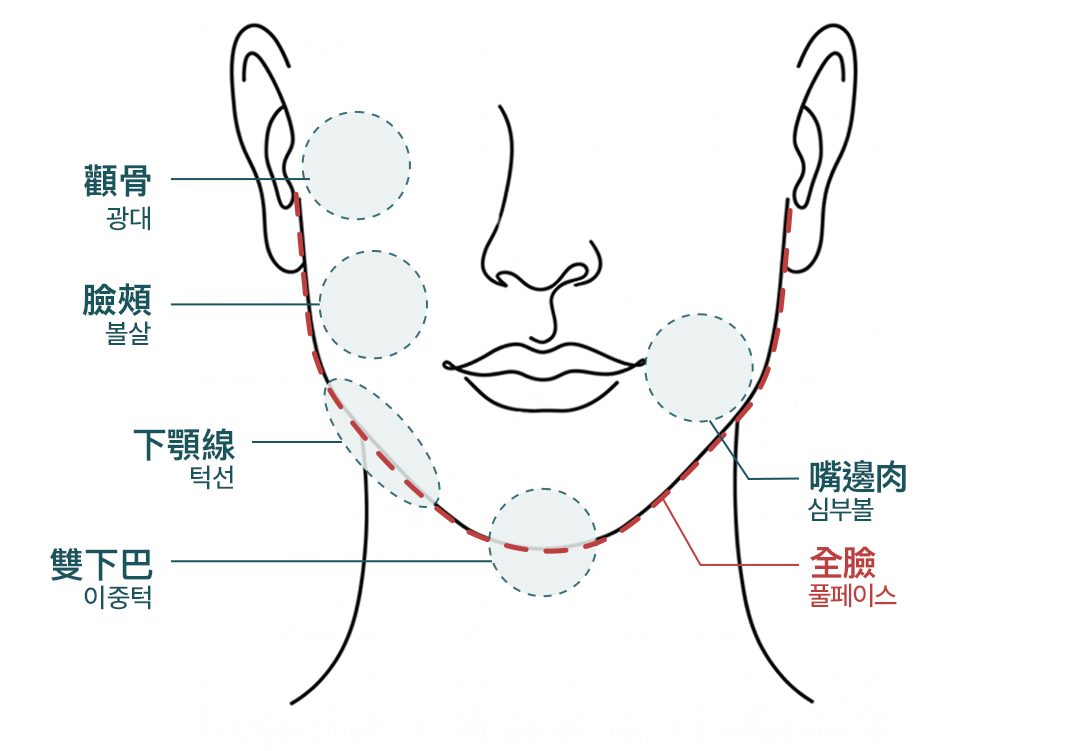 WonderFit 消脂針臉部施作部位說明