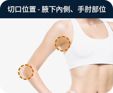 바디 지방흡입 절개부위 겨드랑이 안쪽 팔꿈치