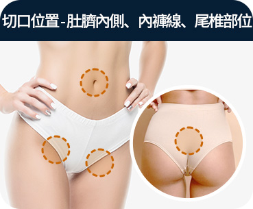 바디 지방흡입 절개부위 배꼽안쪽 팬티라인 꼬리뼈