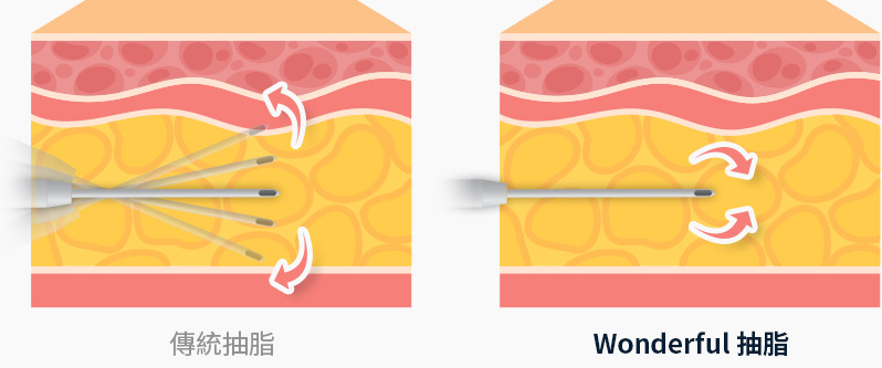 바디 지방흡입 주변조직 손상 최소화 전용캐뉼라 삽입