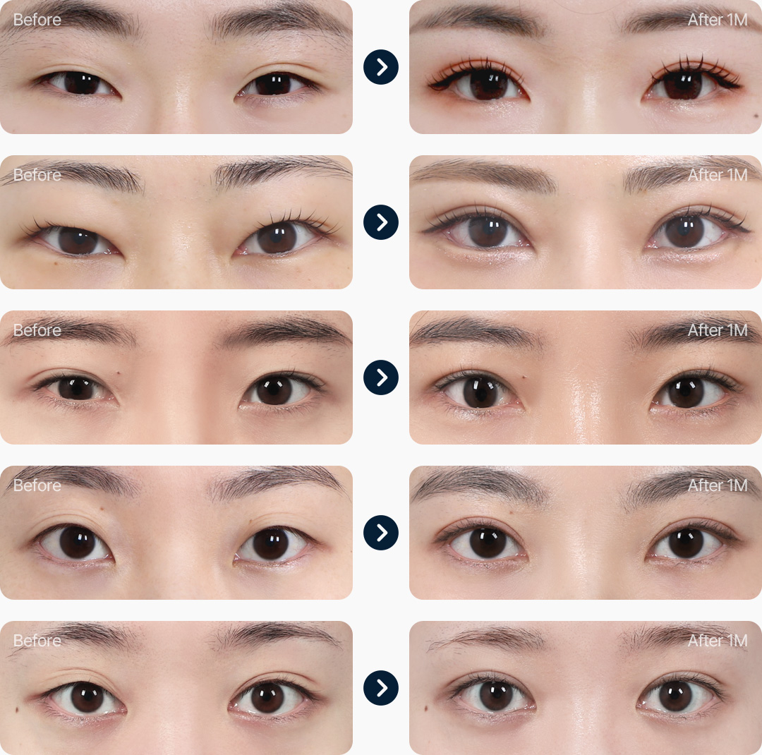 눈매교정 전후사진