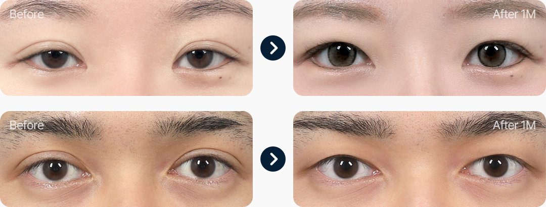 라인낮추기 전후사진