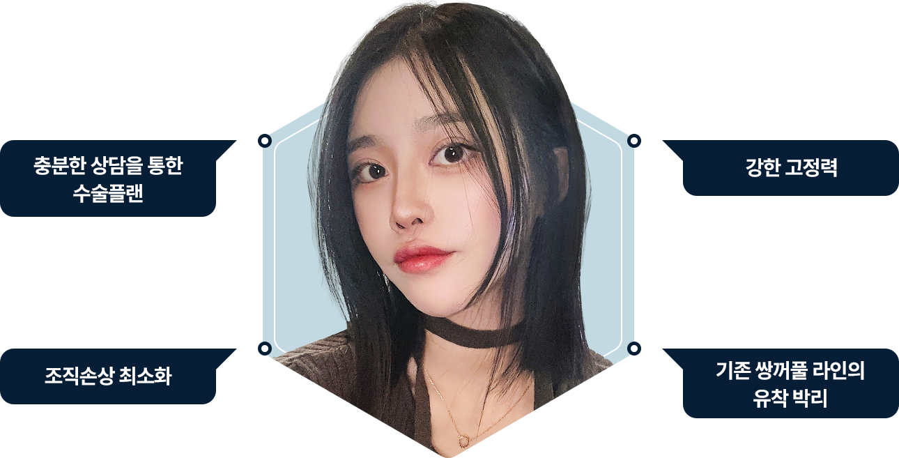 눈재수술 충분한 상담 수술플랜 강한 고정력 조직손상 최소화 기존 쌍꺼풀 유착박리