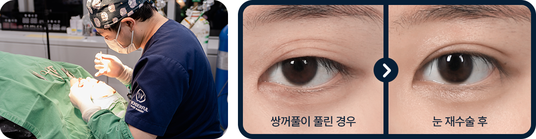 눈재수술 전후사진 원더풀 노하우 강한 고정력