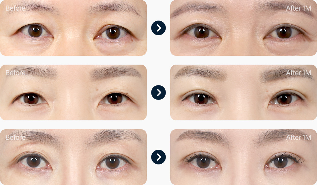 라인낮추기 전후사진