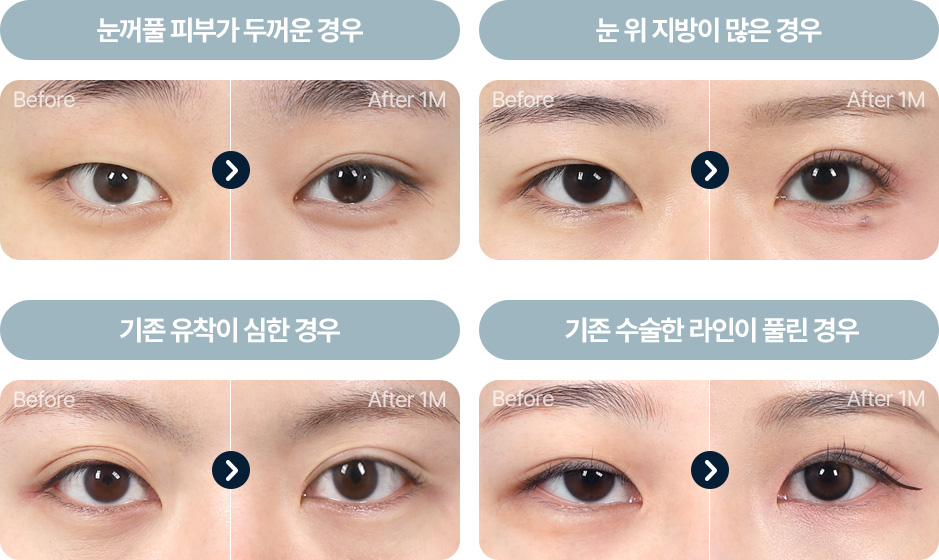 Wonderful 部分切開 피부 근육이 두꺼운 경우 피부 처짐 눈위 지방이 많은경우 기존 유착이 심한경우 기존 라인을 낮추는 경우