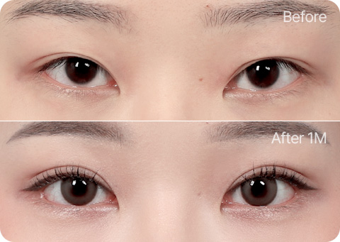 Wonderful 部分切開 눈재수술 윗트임 눈매교정 뒤밑트임