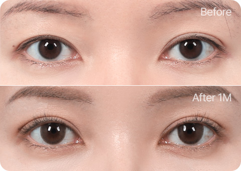 Wonderful 部分切開 눈재수술