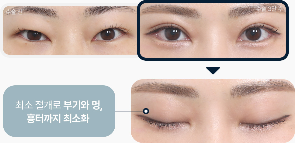 원더풀 라인낮추기 두줄따기 흉터제거 자연스러운 유착