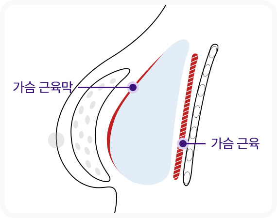 근막하 보형물 삽입 가슴근육막 가슴근육 사이
