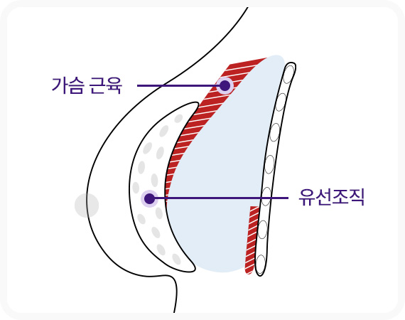 이중평면 보형물 삽입 가슴급육 아래 박리 유선조직 위