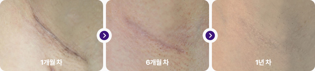 겨드랑이 절개 후기 1개월차 6개월차 1년차