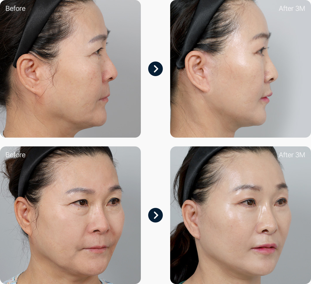 안면거상 전후사진 안면거상후기