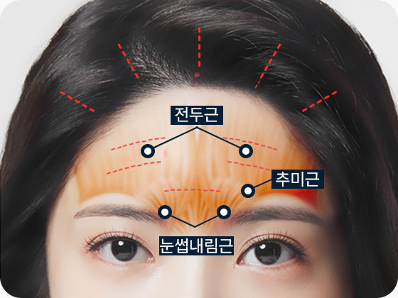 이마거상 전두근 추미근 눈썹내림근 섬세한 절개 및 박리 