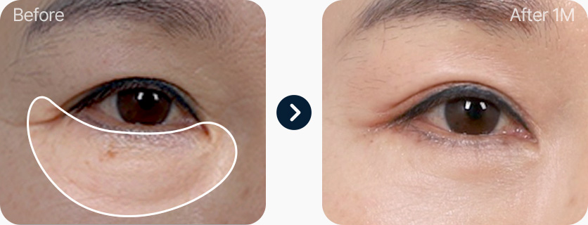 하안검 전후사진 하안검 후기 늘어진 눈밑