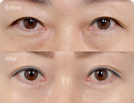 하안검 전후사진 하안검 후기