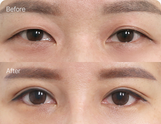 상안검 전후사진 상안검 후기