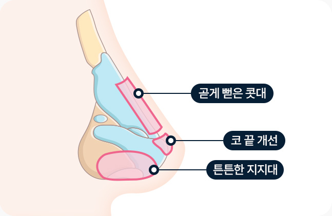 코라인 곧게 뻗은 콧대 코 끝 개선 튼튼한 지지대