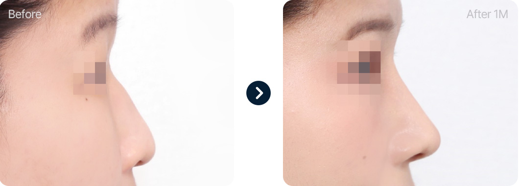 매부리코 성형 전후사진