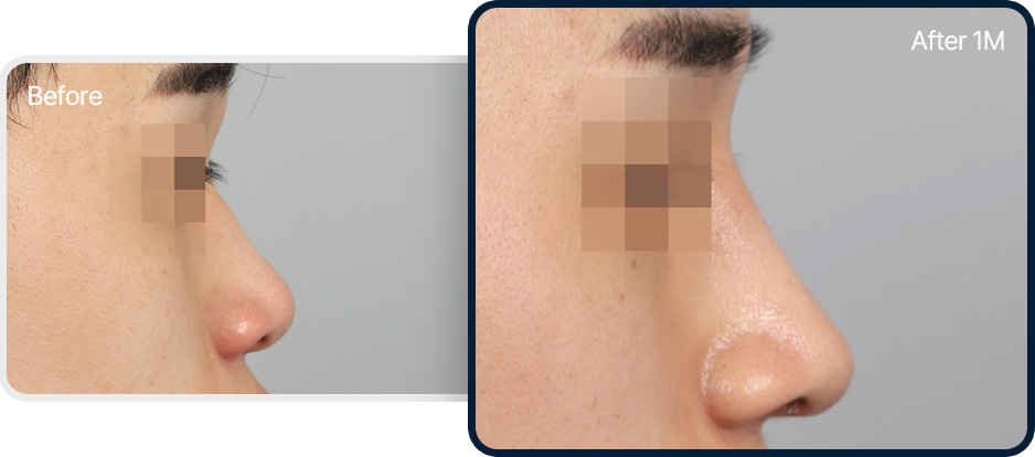 짧은코 성형 전후사진