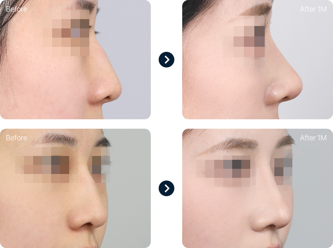 화살코 긴코 성형 전후사진