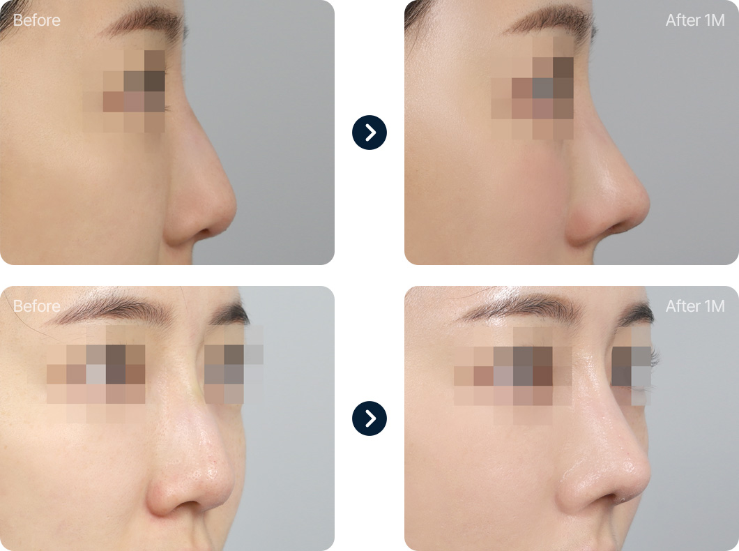 화살코 긴코 성형 전후사진