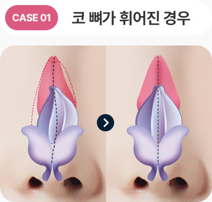 코뼈가 휘어진 경우