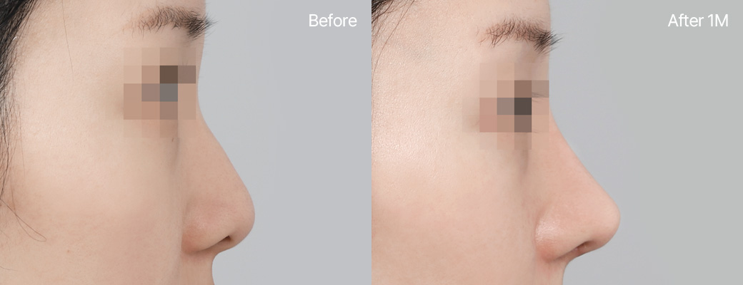 기본코성형 비중격연골+귀연골 전후사진